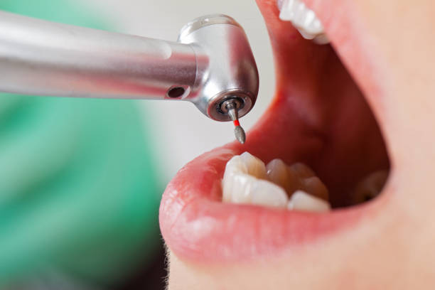 Best Urgent Care for Lost Fillings or Crowns in Pineville, NC